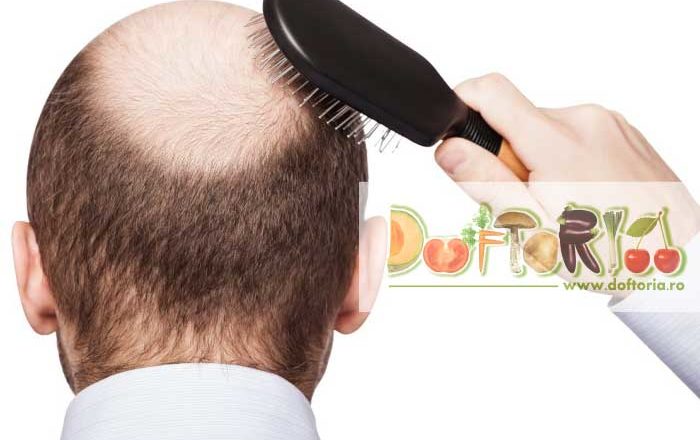 alopecia doftoria