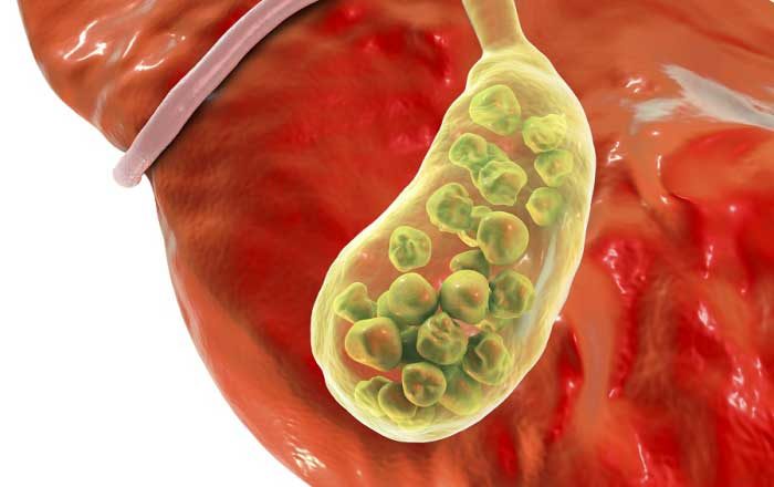 simptomele litiazei biliare