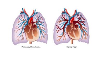 hipertensiune pulmonară