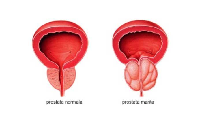 prostată mărită tratament durerea la rinichi