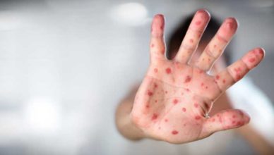 rujeola simptome tratament