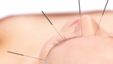 Acupunctura