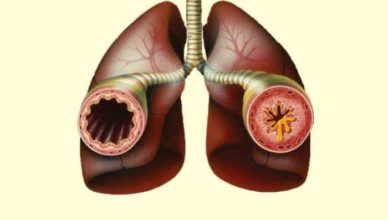 Sindromul Churg Strauss