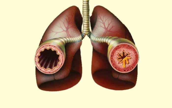Sindromul Churg Strauss