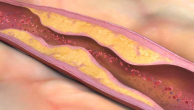 când apare ateroscleroza