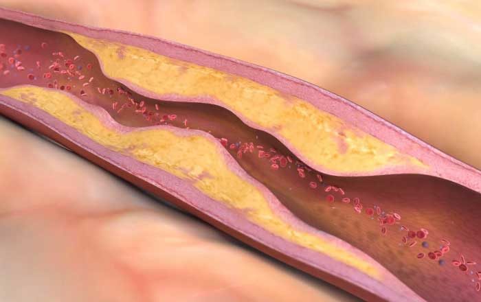 când apare ateroscleroza