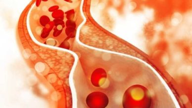 Bolile arterelor şi ale venelor